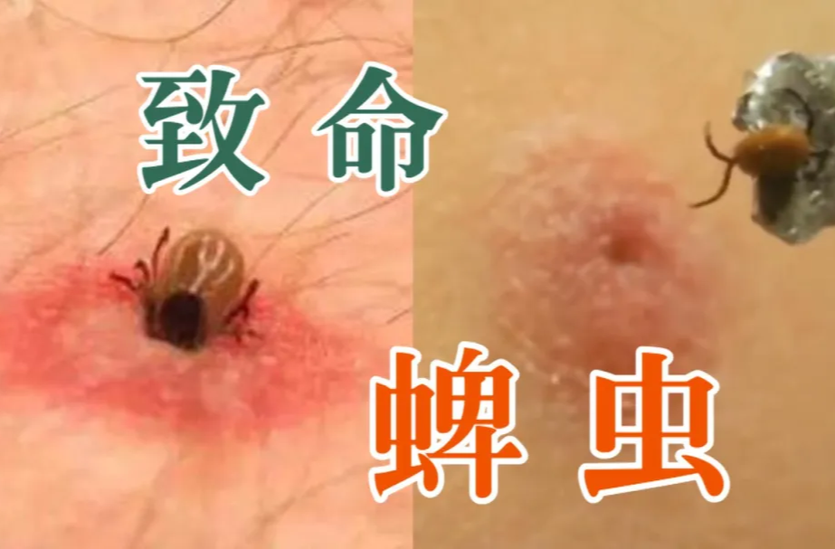 不痛不痒却可致命！外出游玩警惕蜱虫咬伤