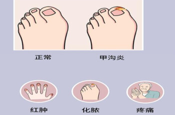 甲沟炎夏季高发，做好预防很重要