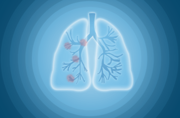 这类人更容易得肺结节！看完赶紧改——专家帮您扫除肺结节盲区