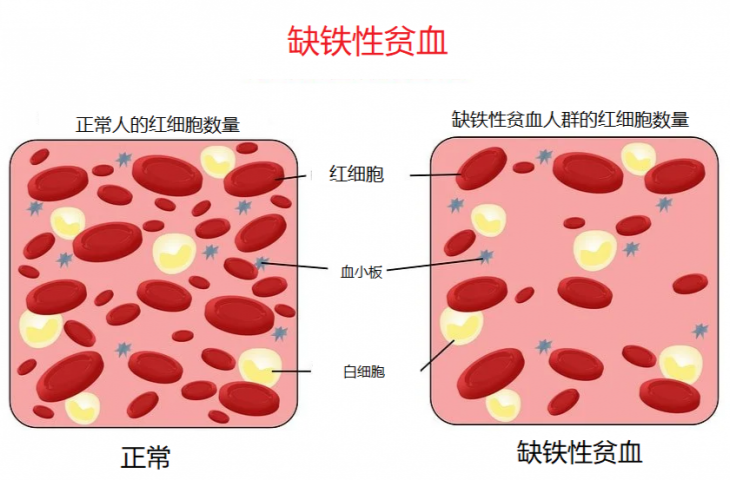 武汉京科白癜风医院：白癜风与缺铁性贫血有什么关系