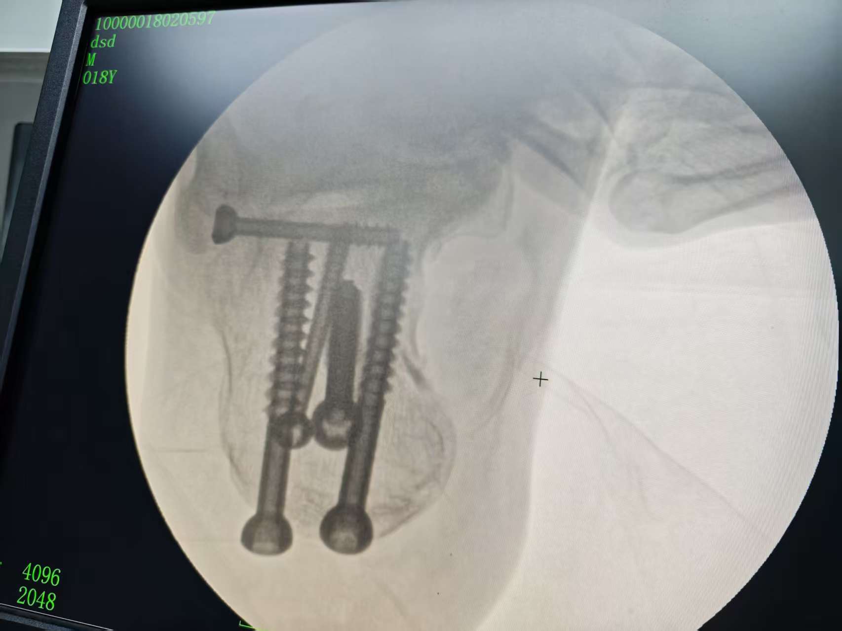 微创技术解病痛，精准医疗再上新台阶——中方县人民医院成功开展左跟骨骨折闭合复位微创内固定术